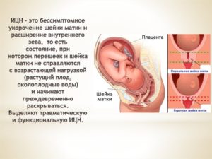 Симптомы укорочения шейки матки при беременности