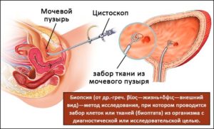 Биопсия мочевого пузыря у мужчин