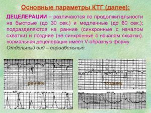 Децелерация на ктг что это