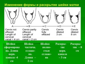 Почему укорачивается шейка матки при беременности