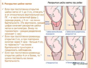 Длинная шейка матки перед родами что делать