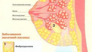 Уплотнение в молочной железе перед месячными