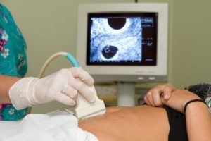 Лечение варикозного расширения вен матки