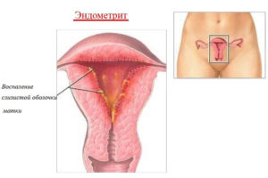 Что такое эндометрит матки