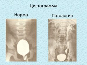 Цистограмма как делают детям