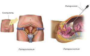 Лапаротомия кисты яичника