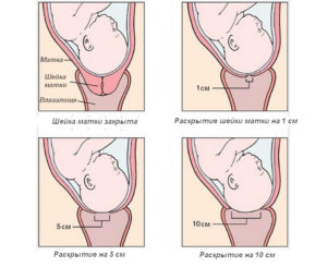 Что означает мягкая шейка матки