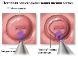 Электроконизация шейки матки при дисплазии