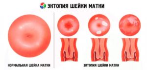 Чем опасна эрозия шейки матки у нерожавших девушек