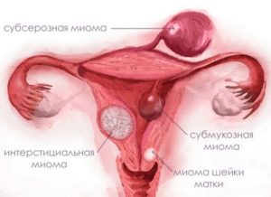 Интерстициально субсерозная миома матки что это такое