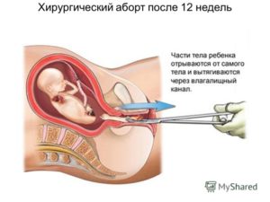 Половая жизнь после выскабливания