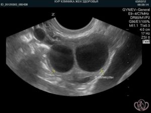 Функциональная киста правого и левого яичника