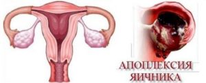 Симптомы разрыва яичника у женщин
