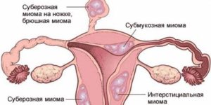 Можно ли делать эко при миоме матки