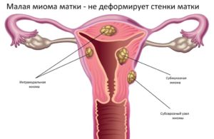 Чем опасна миома матки больших размеров