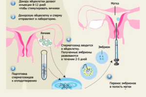 Донор яйцеклеток как это происходит