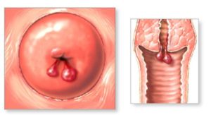 Шишки на шейке матки