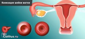 Как делают конизацию шейки матки