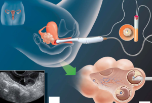 Пункция яичников