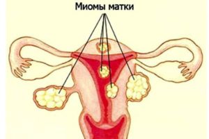 Чем миома отличается от фибромы матки