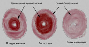 Лечение эрозии шейки матки при разных симптомах