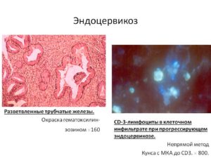Что такое стационарный эндоцервикоз шейки матки