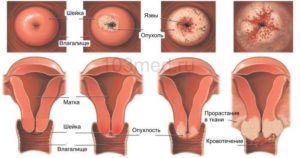 От чего бывает рак матки