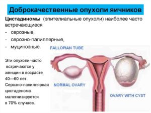 Злокачественные и доброкачественные опухоли яичников