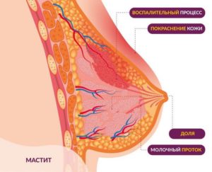 Мастит у некормящих женщин