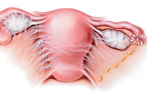 Спайки яичников: симптомы и лечение