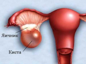 Выделения при кисте яичника