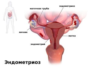 Противопоказания при эндометриозе