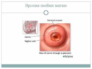 Психосоматика и эрозия шейки матки