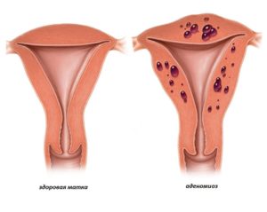 Что такое аденоматоз эндометрия