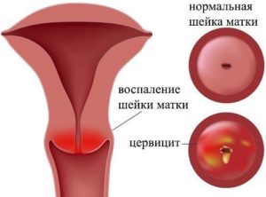 Как лечить воспаление матки