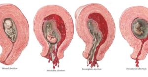 Медикаментозный аборт при замершей беременности