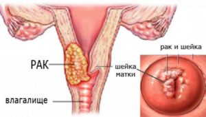 От чего бывает рак матки