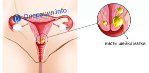 Удаление кисты шейки матки