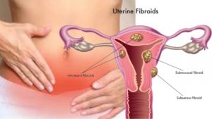 Лечение фибромы матки