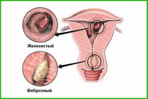 Причины возникновения полипа цервикального канала