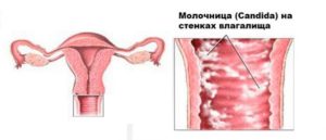 Как можно заразиться молочницей женщине