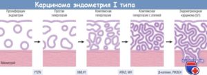 Эндометрий пролиферативного типа что это такое