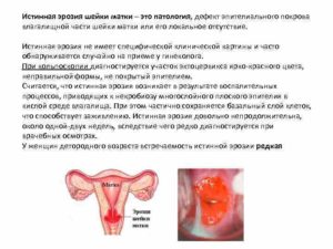 Что называют истинной эрозией шейки матки