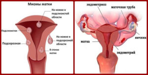 Миома матки и эндометриоз