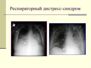 Респираторный дистресс синдром у детей