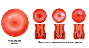 Маленькая эрозия шейки матки