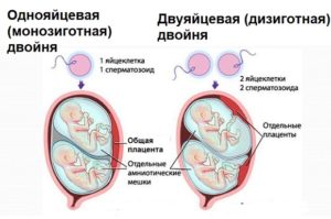 Редукция эмбриона при многоплодной беременности