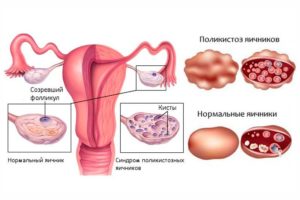 Поликистоз яичников: симптомы и лечение