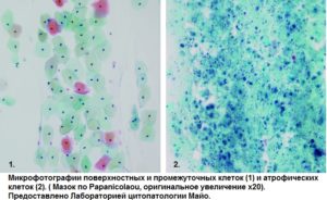 Что такое атрофический тип мазка