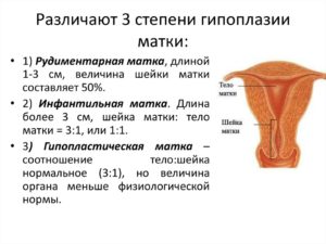 Инфантилизм матки